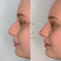 The Ins and Outs of Rhinoplasty: What You Need to Know