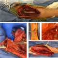 Understanding Limb Reconstruction: From Injuries to Enhancements