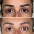 All You Need to Know About Brow Lift