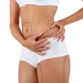 All You Need to Know About Liposuction