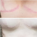 Breast Scar Treatment: Enhance Your Appearance and Boost Your Confidence