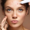 Understanding Acne Treatment