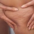 Understanding Cellulite Treatment: What You Need to Know