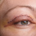 The Ins and Outs of Eyelid Surgery: What You Need to Know