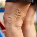 Varicose Vein Treatment: What You Need to Know