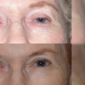 All About Eyelid Surgery: A Comprehensive Guide to Facial Procedures