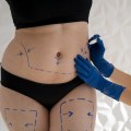 Tummy Tuck: A Comprehensive Guide to the Procedure