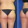 All You Need to Know About Buttock Augmentation