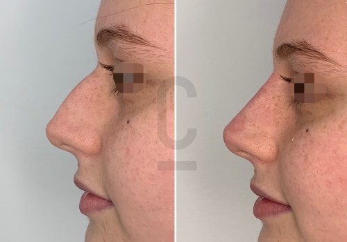 The Ins and Outs of Rhinoplasty: What You Need to Know