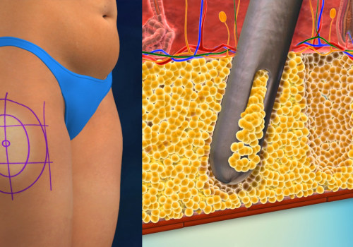 The Ins and Outs of Liposuction: What You Need to Know