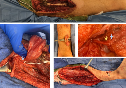 Understanding Limb Reconstruction: From Injuries to Enhancements