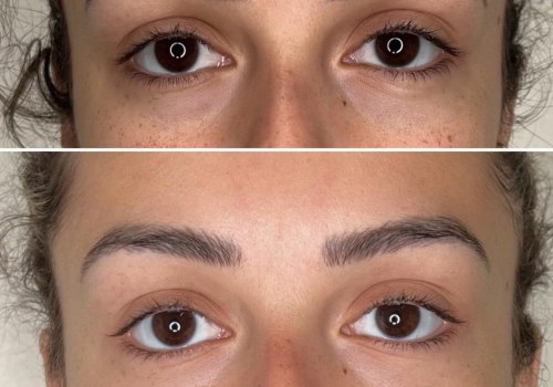 All You Need to Know About Brow Lift