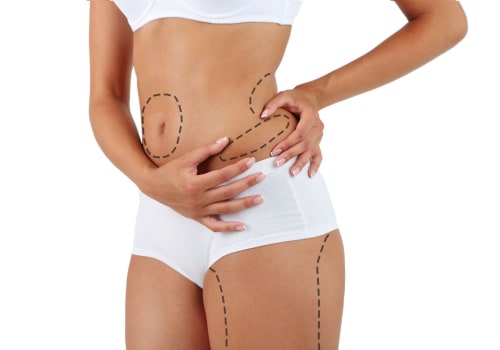 All You Need to Know About Liposuction