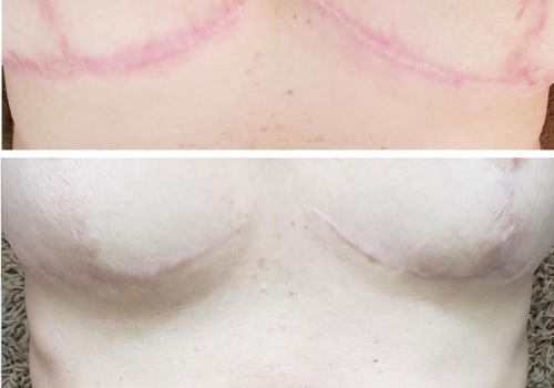 Breast Scar Treatment: Enhance Your Appearance and Boost Your Confidence