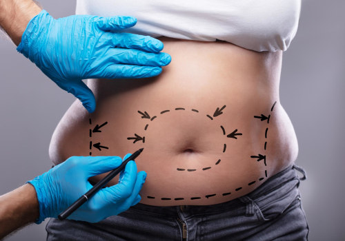 All About Tummy Tucks: What You Need to Know Before Going Under the Knife