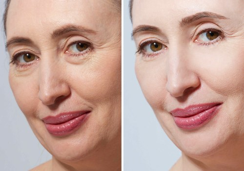 The Benefits of a Facelift: What You Need to Know