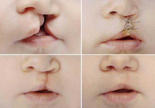 Cleft Lip and Palate Repair: A Guide to Reconstructive Procedures