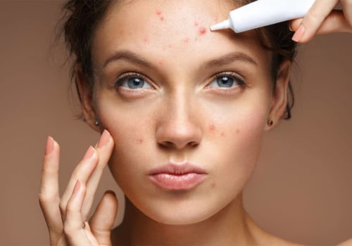 Understanding Acne Treatment