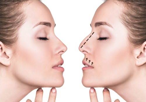 Understanding Rhinoplasty: Enhancing Your Appearance or Correcting Defects