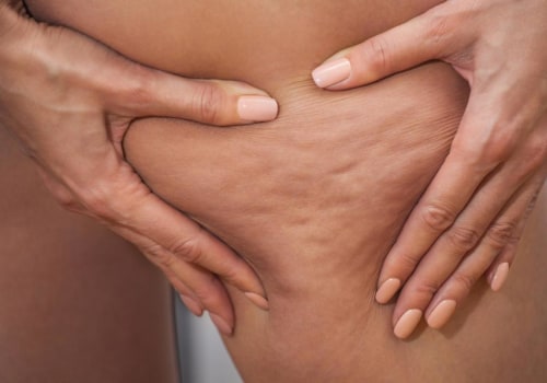 Understanding Cellulite Treatment: What You Need to Know