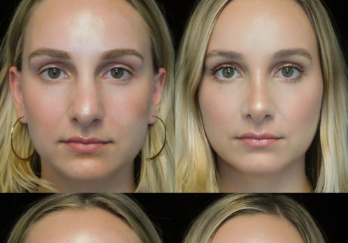 Everything You Need to Know About Rhinoplasty