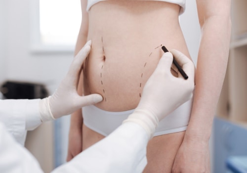 All You Need to Know About Liposuction: A Guide to Body Procedures