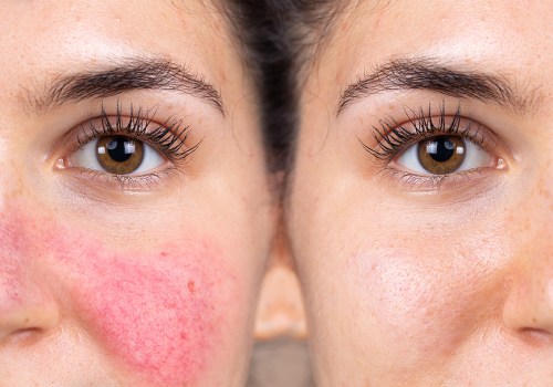 Understanding Rosacea Treatment: Everything You Need to Know