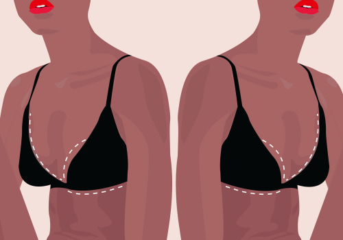 Breast Reduction: A Guide to Understanding the Procedure