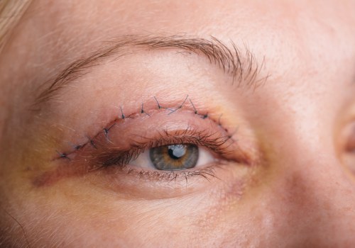 The Ins and Outs of Eyelid Surgery: What You Need to Know