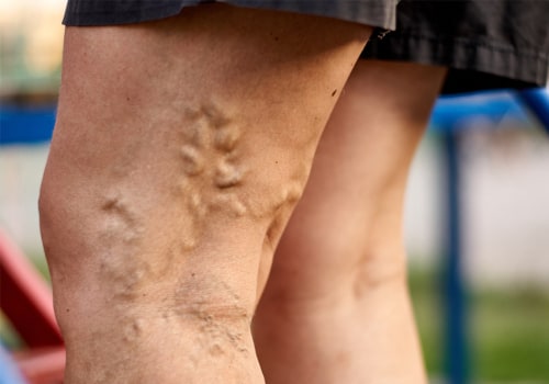 Varicose Vein Treatment: What You Need to Know