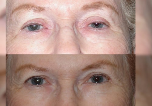 All About Eyelid Surgery: A Comprehensive Guide to Facial Procedures