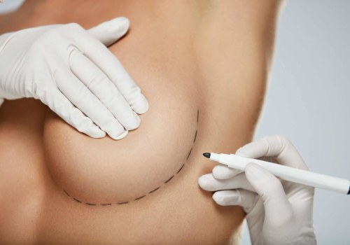 A Comprehensive Guide to Breast Reconstruction