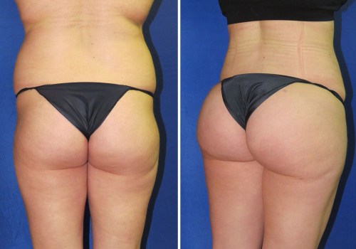 All You Need to Know About Buttock Augmentation